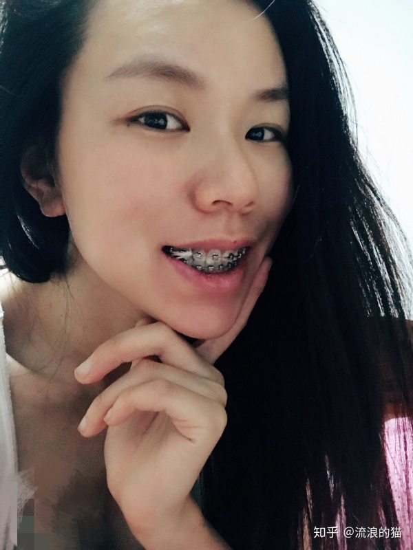来说说牙齿矫正挂小皮筋是什么感受