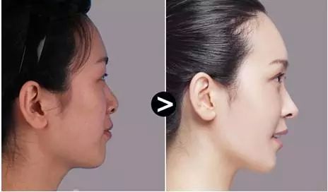 用鼻子和用嘴呼吸对脸型真的有影响么?