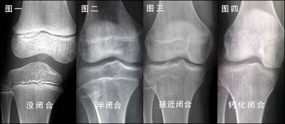 骺板间隙图片